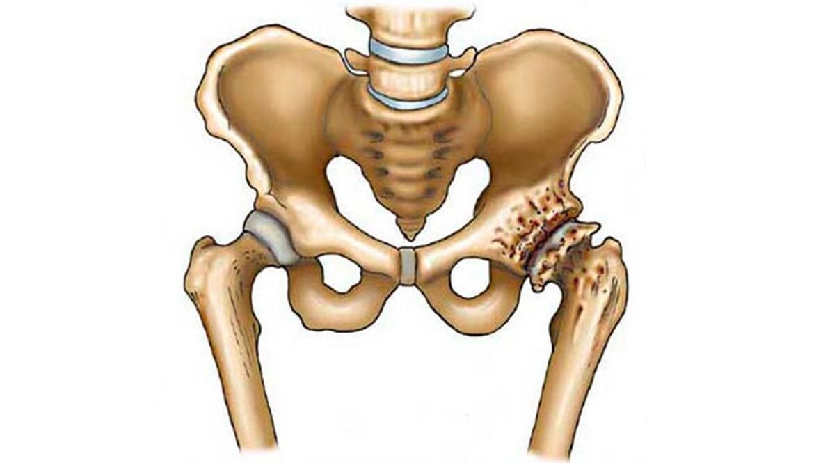 hip joint damage in the presence of arthrosis