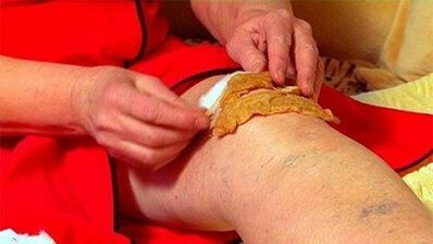 Compresses for knee wrist arthritis