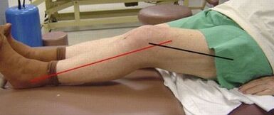 Progressive arthrosis of knee joint