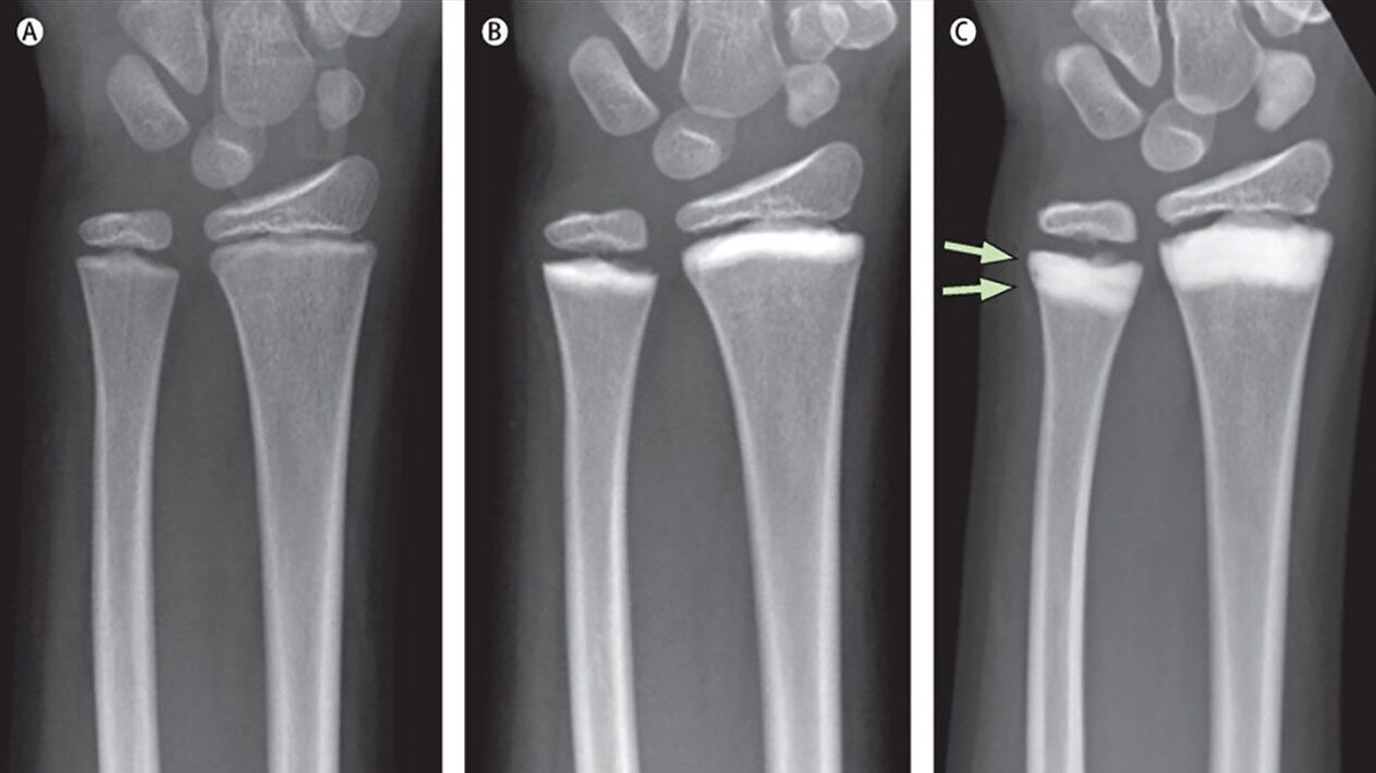radiography of the right joint