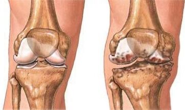 Knee arthrosis