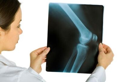 Treatment Arthrosis Knee joint