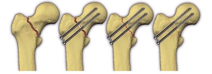 fixation of the body of the bone with wedges for pain in the hip joint