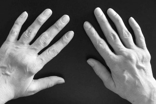disease of the hands